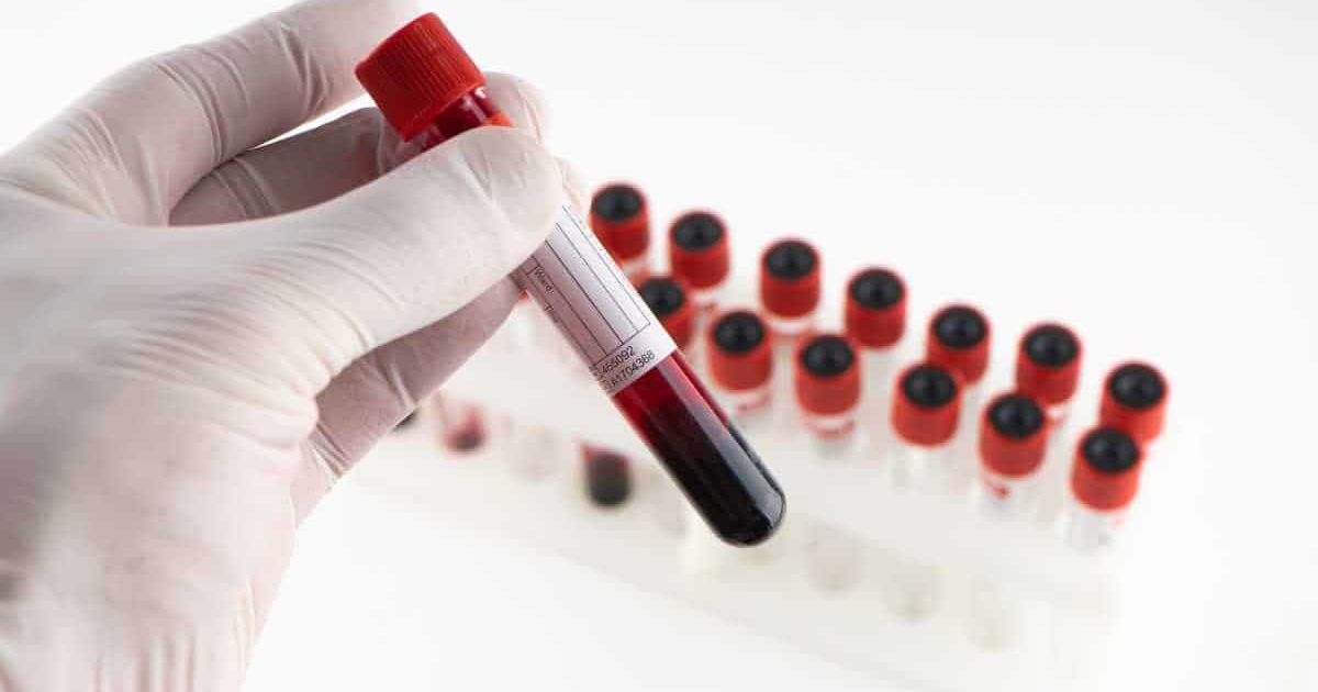 What is MCV in thalassemia? THIP Media