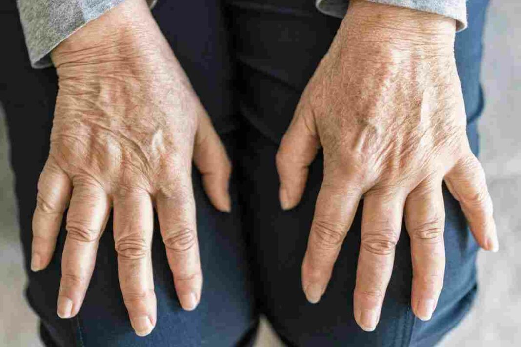 osteoarthritis and rheumatoid arthritis