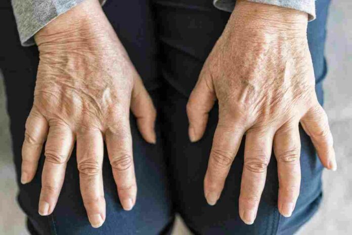 osteoarthritis and rheumatoid arthritis