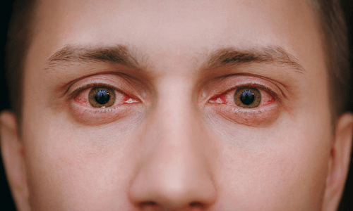 Eye flu