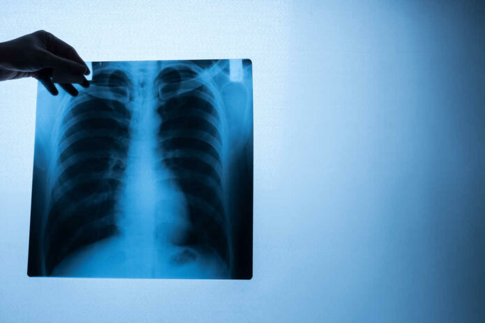 lung cancer early detection