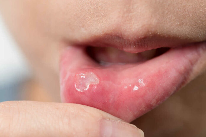 stress and mouth ulcers