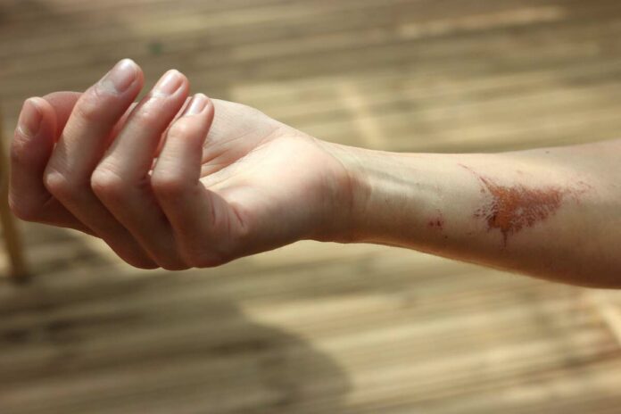 proliferation of scar tissue