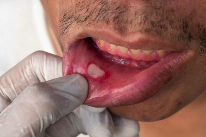 mouth ulcer home remedies