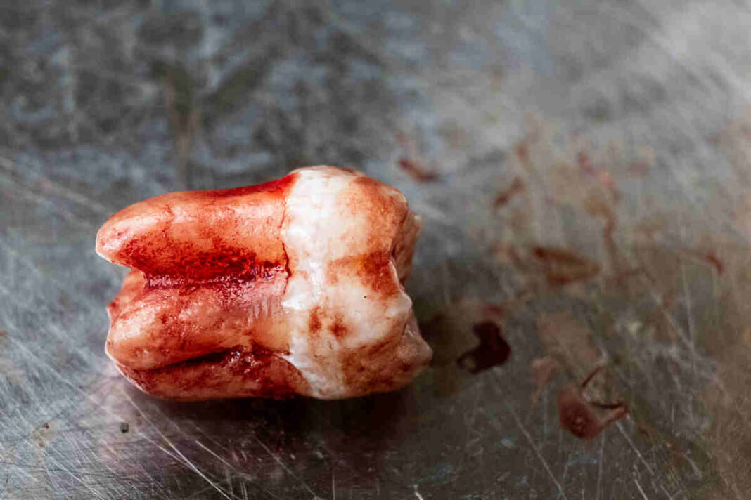 Fact Check Can wisdom teeth removal harm digestive health?