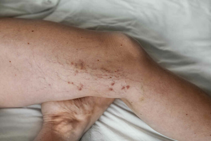 mustard oil and herbs can remove varicose veins