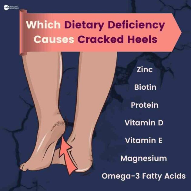 What dietary deficiency causes cracked feet? THIP Media