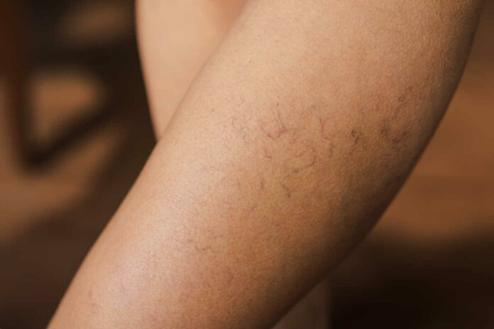 relieve varicose veins