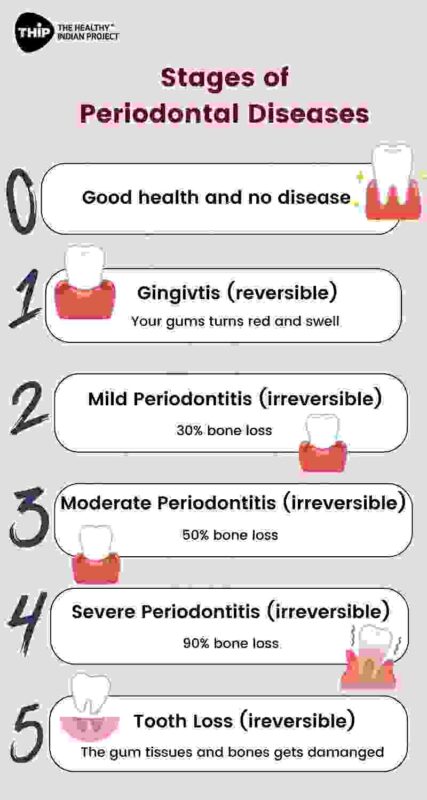infographic displaying the stages of periodontal stages