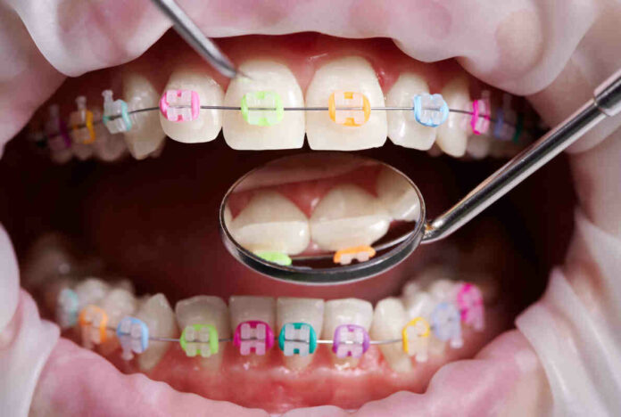 types of braces for teeth