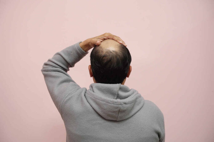 Ayurvedic formula can cure all types of baldness