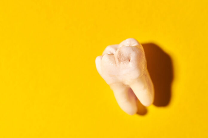 wisdom teeth removal