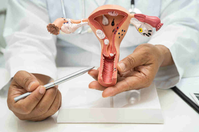 ovarian drilling for pcos
