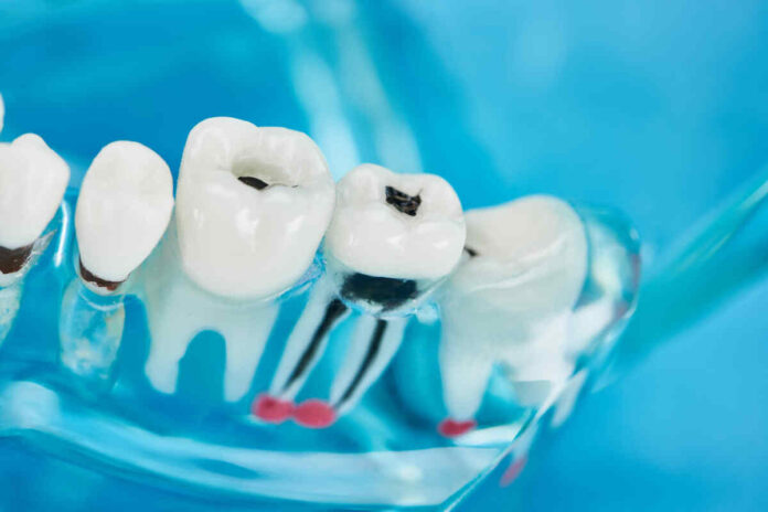 prevent tooth decay