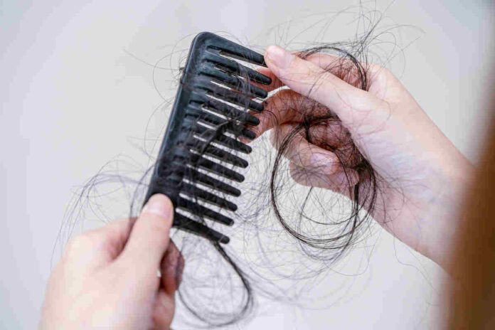 PCOS hair loss