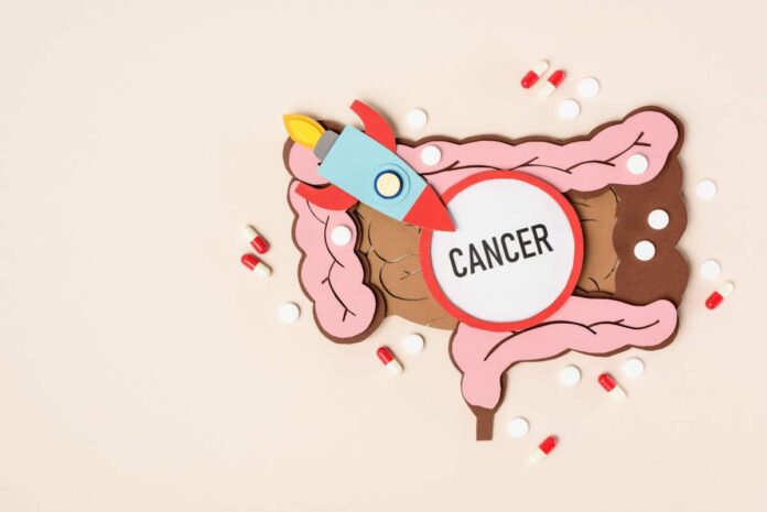 exercise and colon cancer