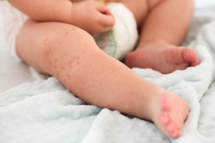 baby's viral rash