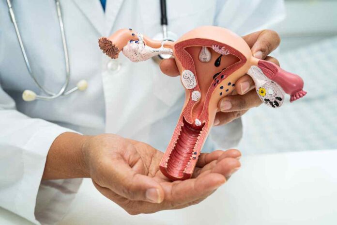endometriosis risk of ovarian cancer