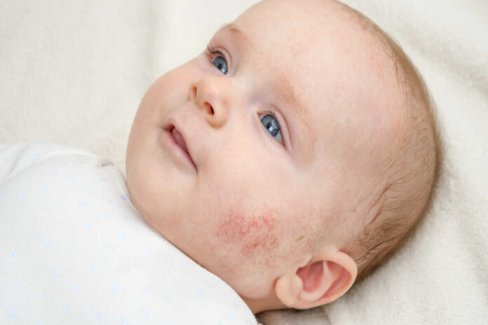 baby acne