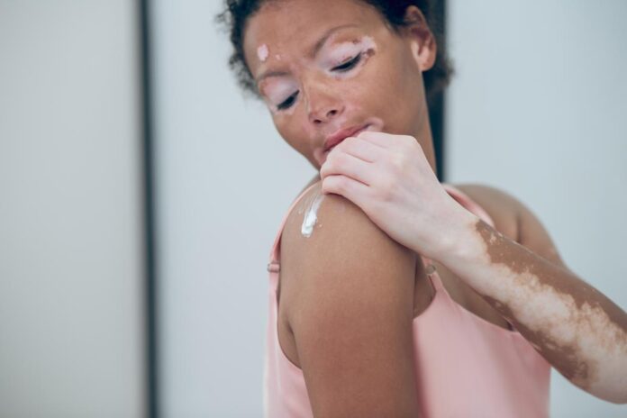 online product for vitiligo