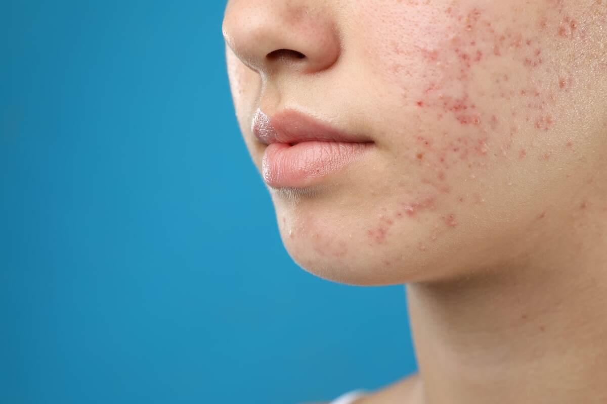 Living with Acne: The Stories of Struggle and Resilience